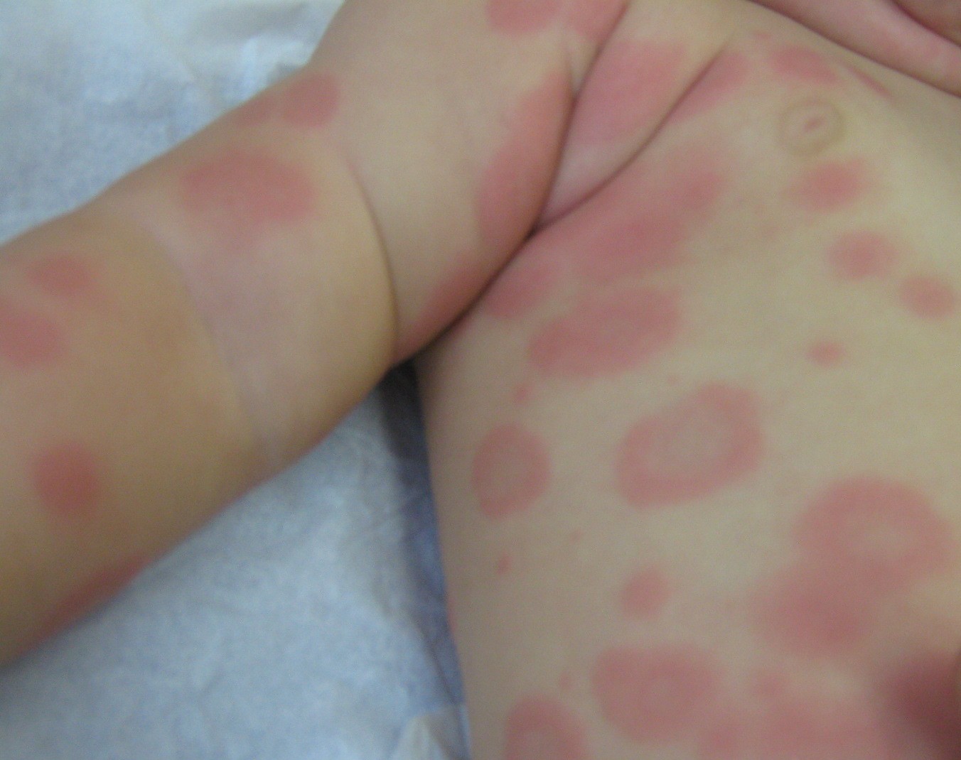 erythema red spots on body