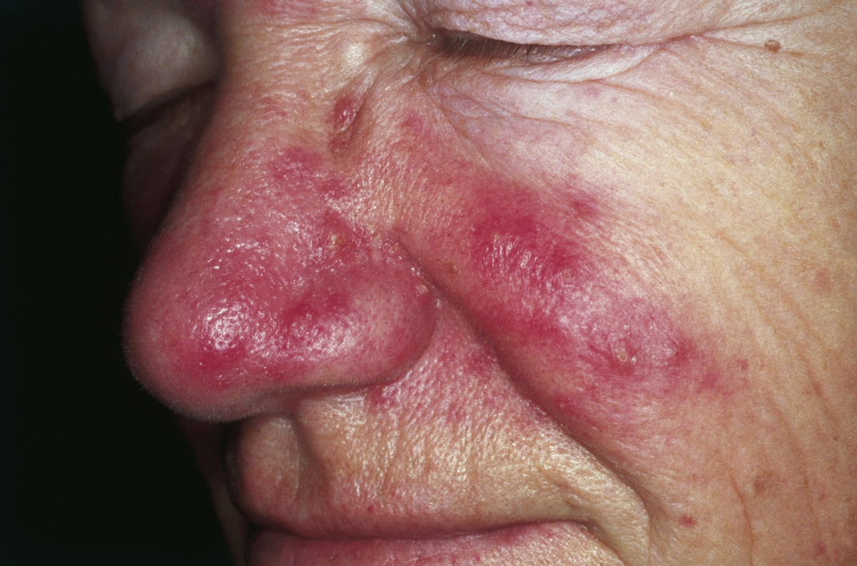 rosacea red face