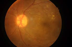 eye with retinopathy