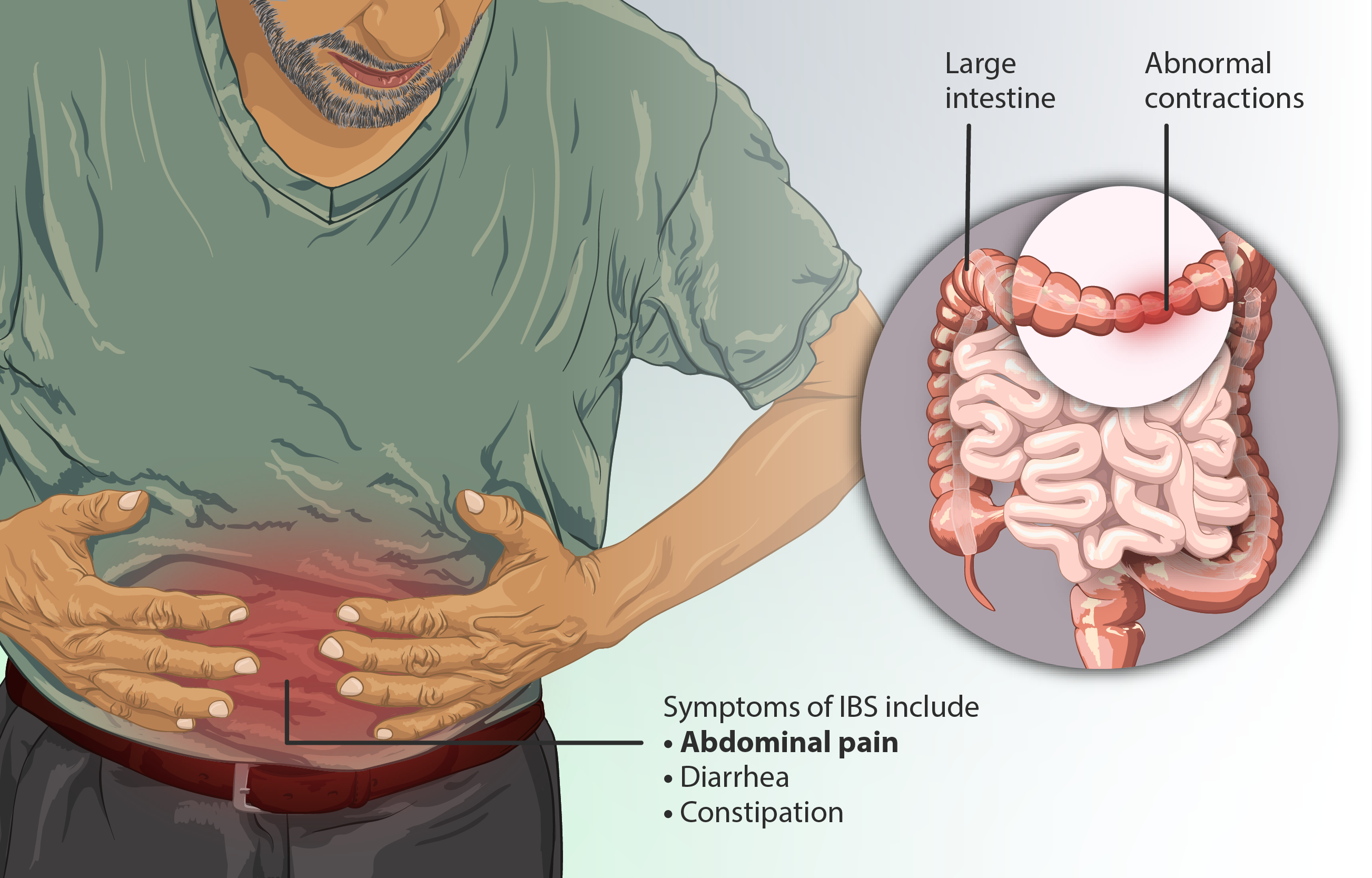 example of irritable bowel syndrome