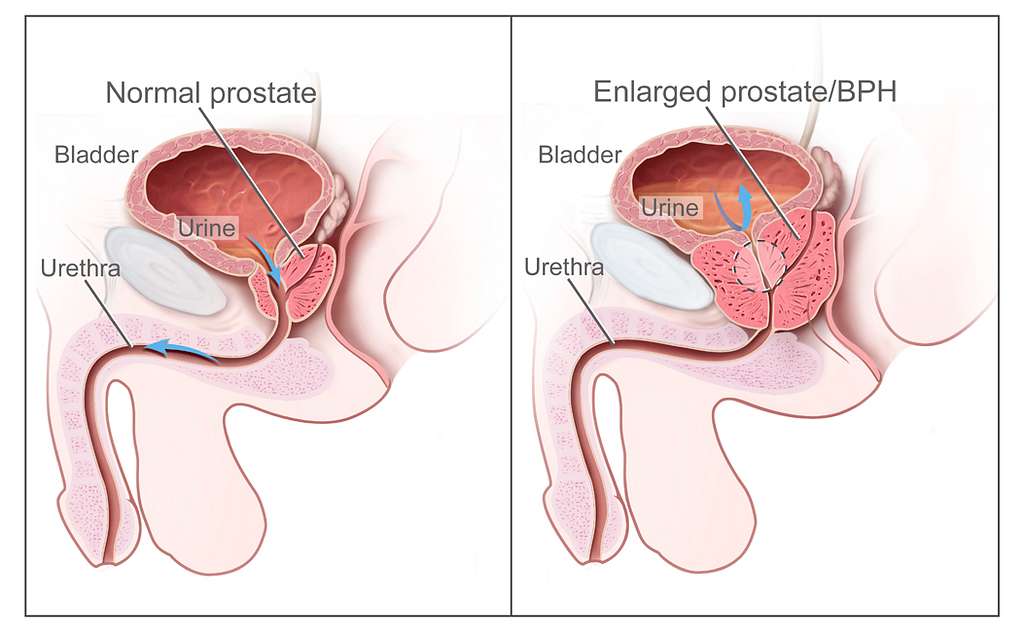 Normal and Enlarged prostate