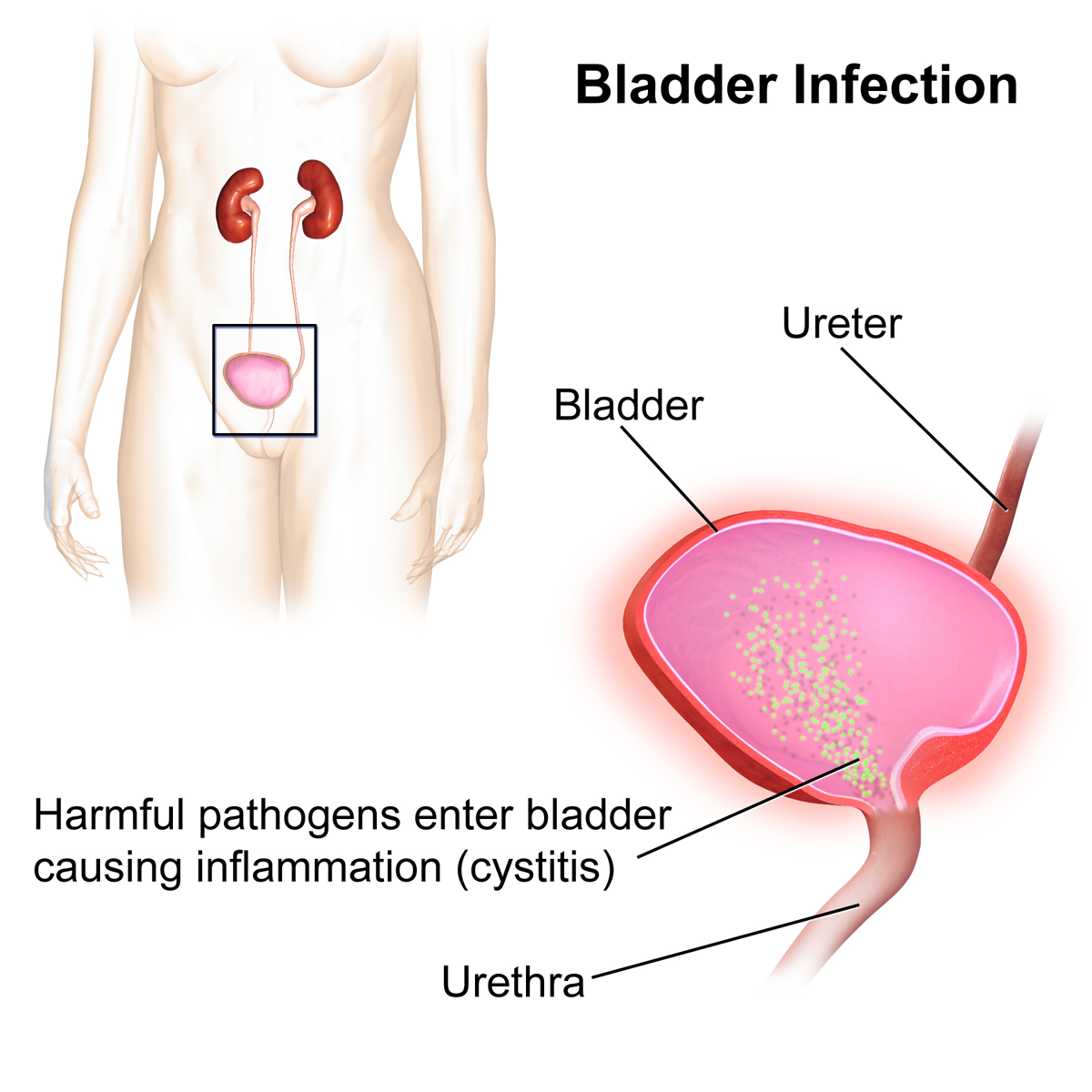 bladder infection in women