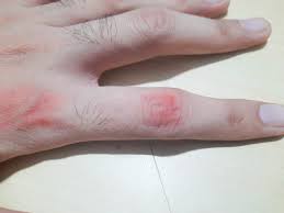 rashes on hand