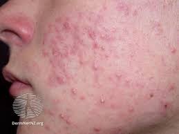 acne on women's face