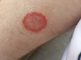 dermatophytosis
