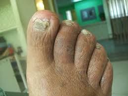 onychomycosis infection on the toe