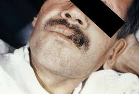 person with histoplasmosis