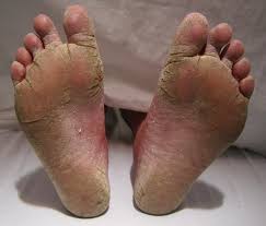 person with athlete foot 