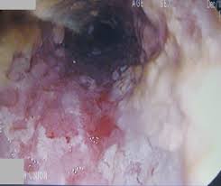 person with candidiasis in the esophagus