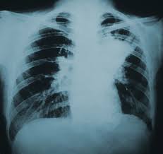 xray of person with pulmonaryBlastomycosis