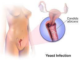 vaginal year infection photos 