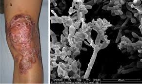 photo showing person with chromoblastomycosis infection