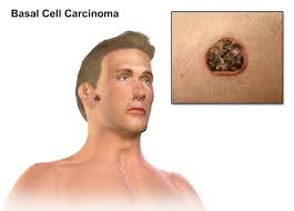 person with basal cell carcinoma