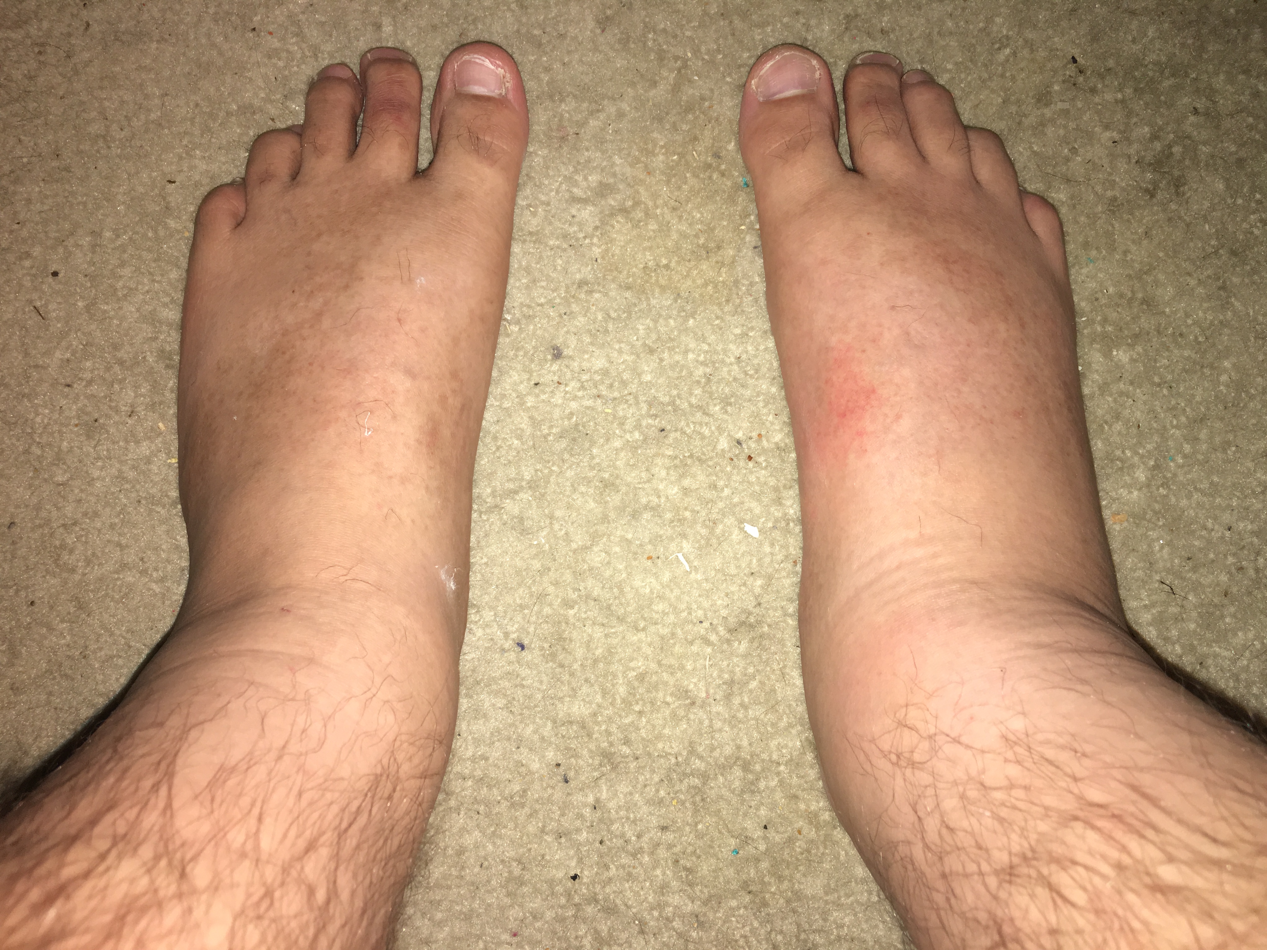 person with leg swelling
