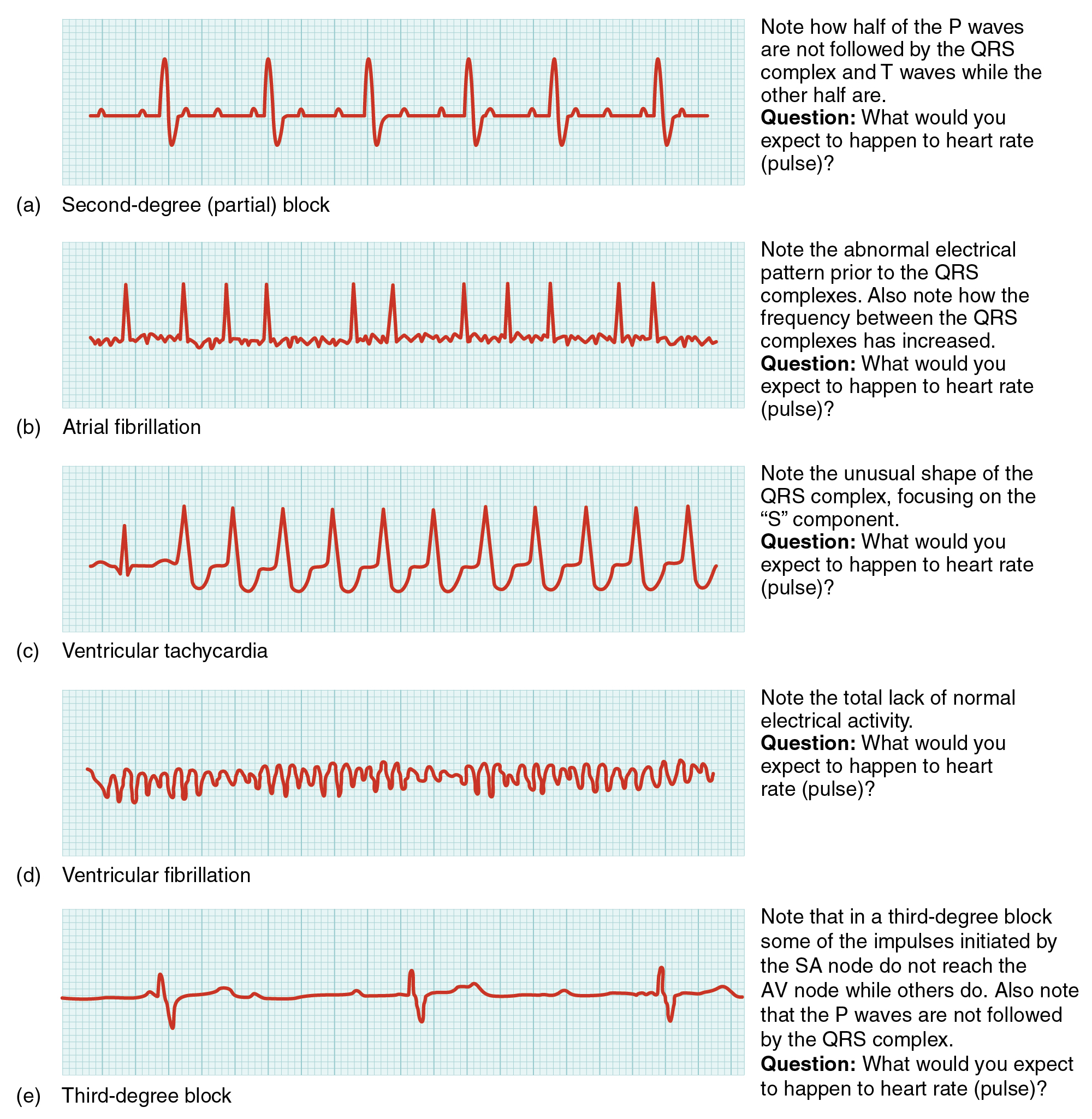 results of person with arrhythmias