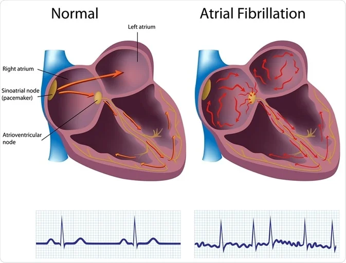 atrial fibrillation in the heart