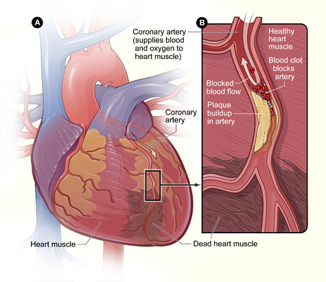 heart damage