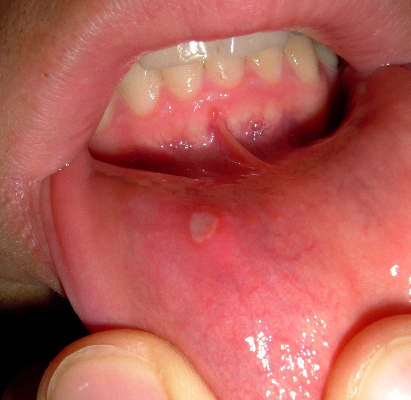 mouth ulcer