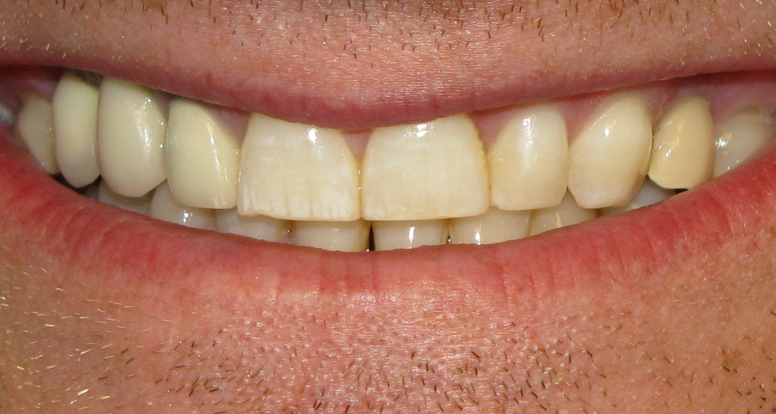 yellowing of enamel