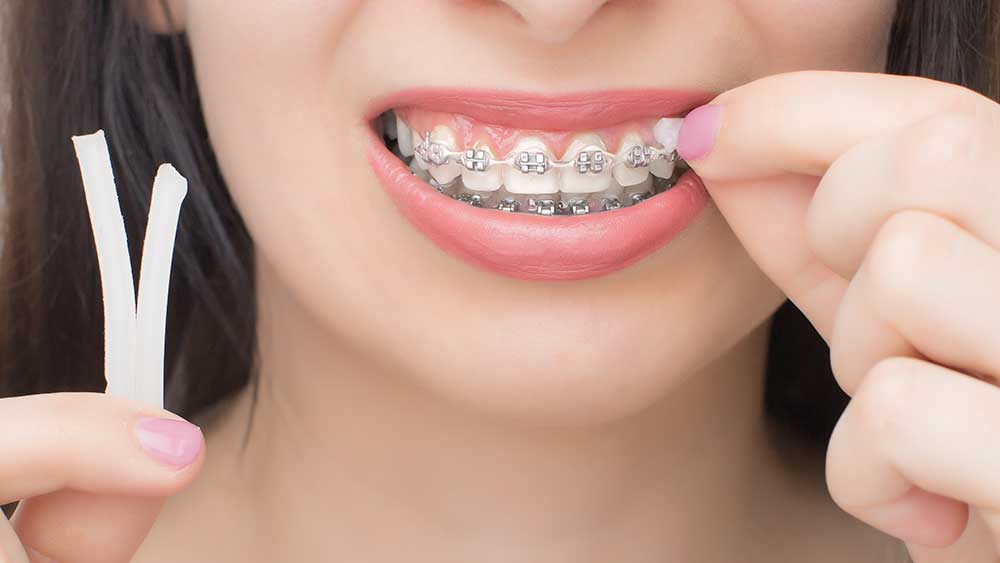 teeth with orthobraces