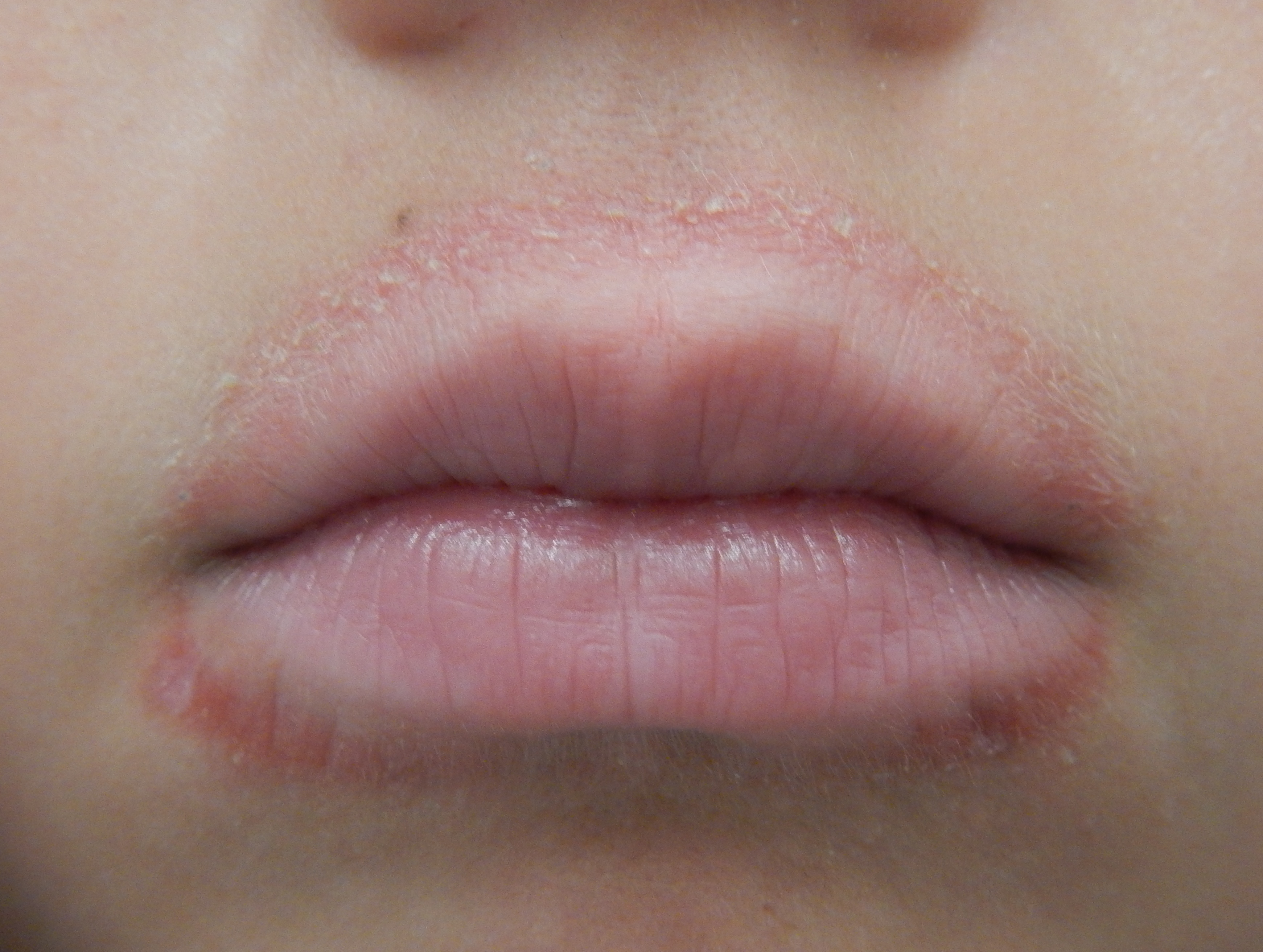 rashes around mouth of child