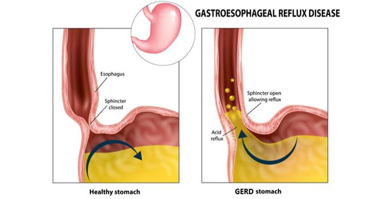 stomach experiencing GERD