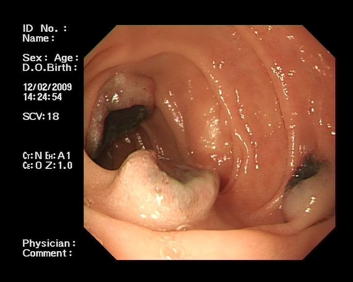 duodenal ulcer scope