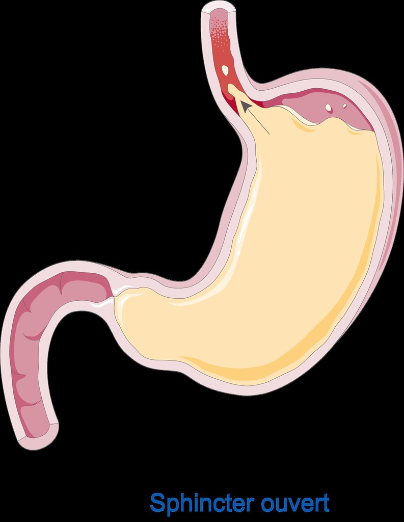 gastric reflux going back into the esophagus