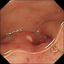  intestinal ulcer scope showing the ulcer