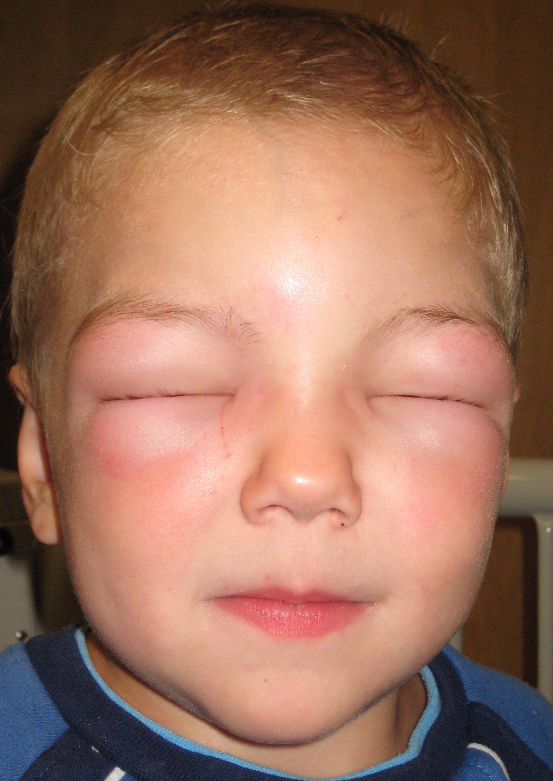 angioedema reaction on the face swollen eyes