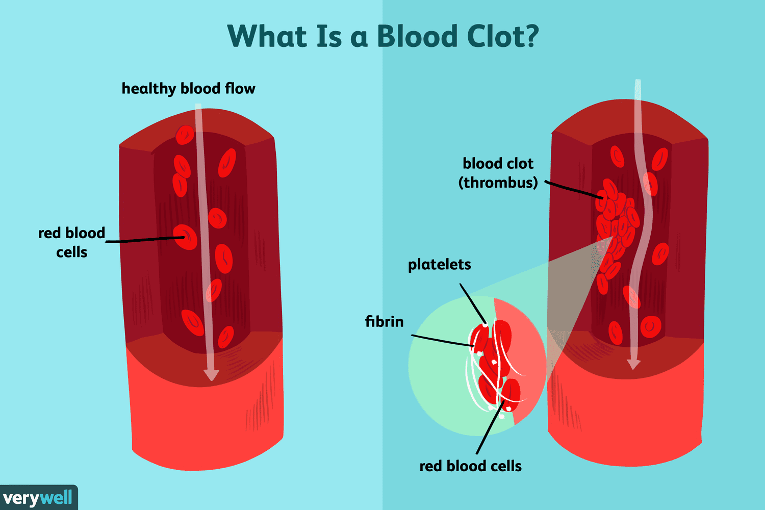 blood clot in the blood vessel