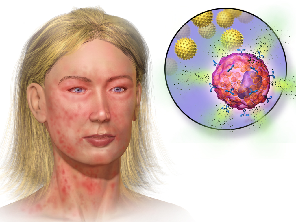 anaphylaxis reaction on the face redness and swelling
