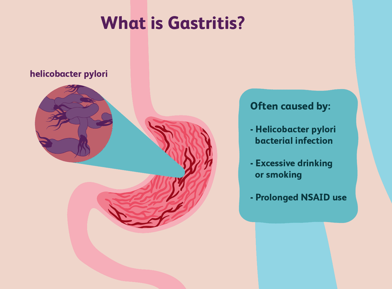 gastritis in the stomach with Heliobactor pylori bacteria