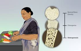 bone density withj a woman standing cutting vegetables 