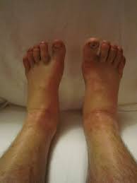 swelling of legs