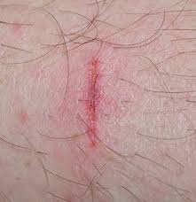 slashed wound