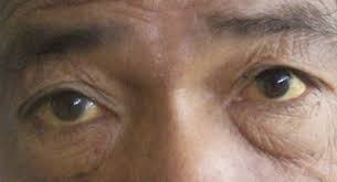 yellowing of eyes