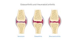 osteoarthritis and rheumatoid arthritis