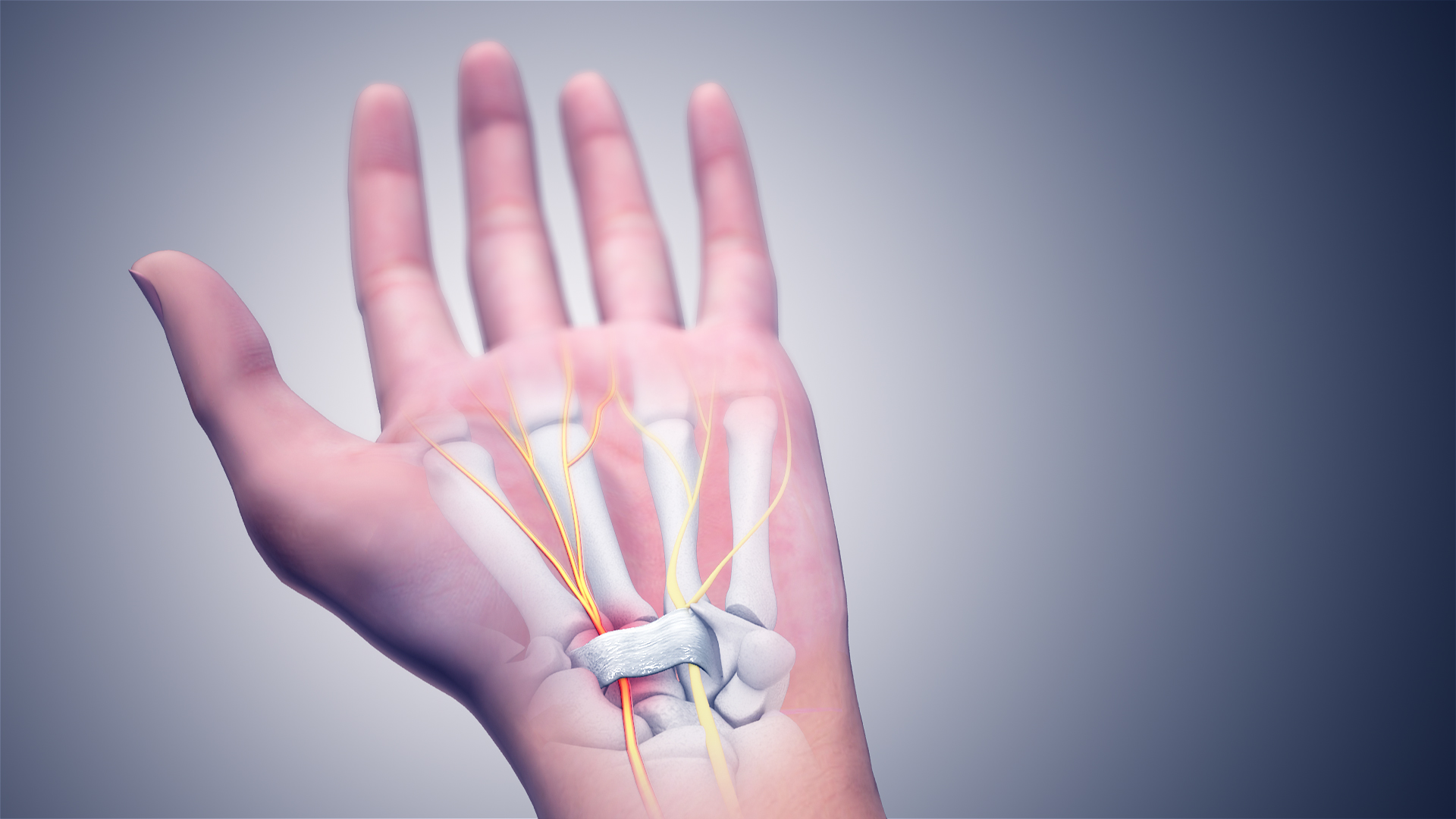 carpal tunnel syndrome