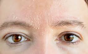 dryness between the eyes