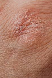 skin on elbow
