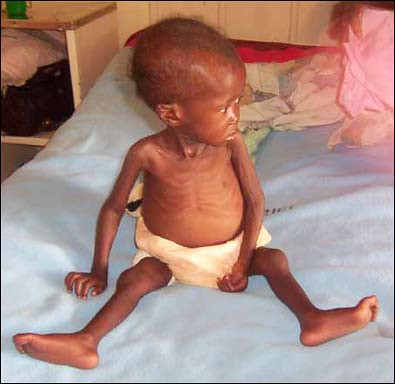 malnourished kid