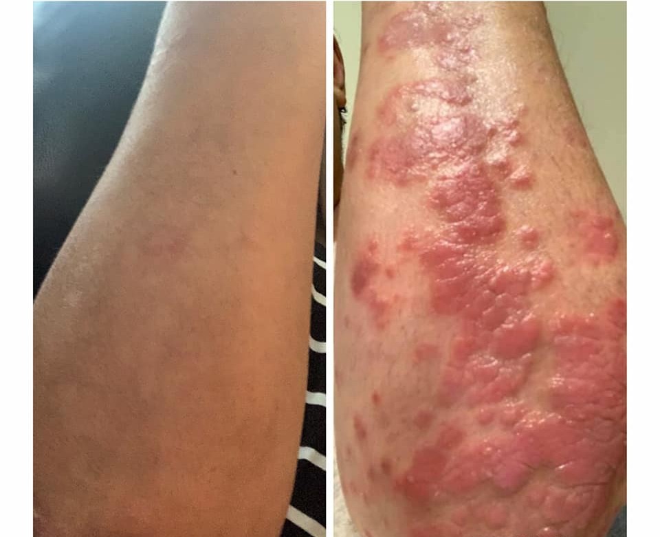 skin rash on forearm before and after recovery
