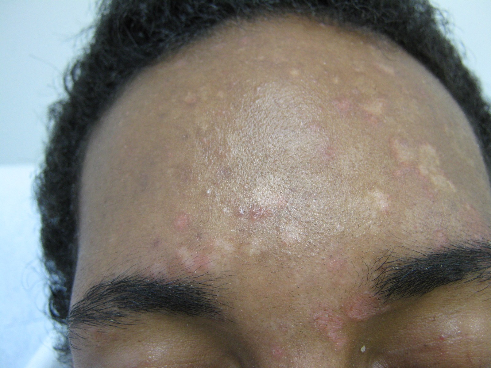 person face with tinea versicolor on the forehead