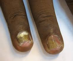 fingernail with fungus infection