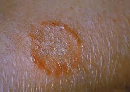 forearm with ringworm infection