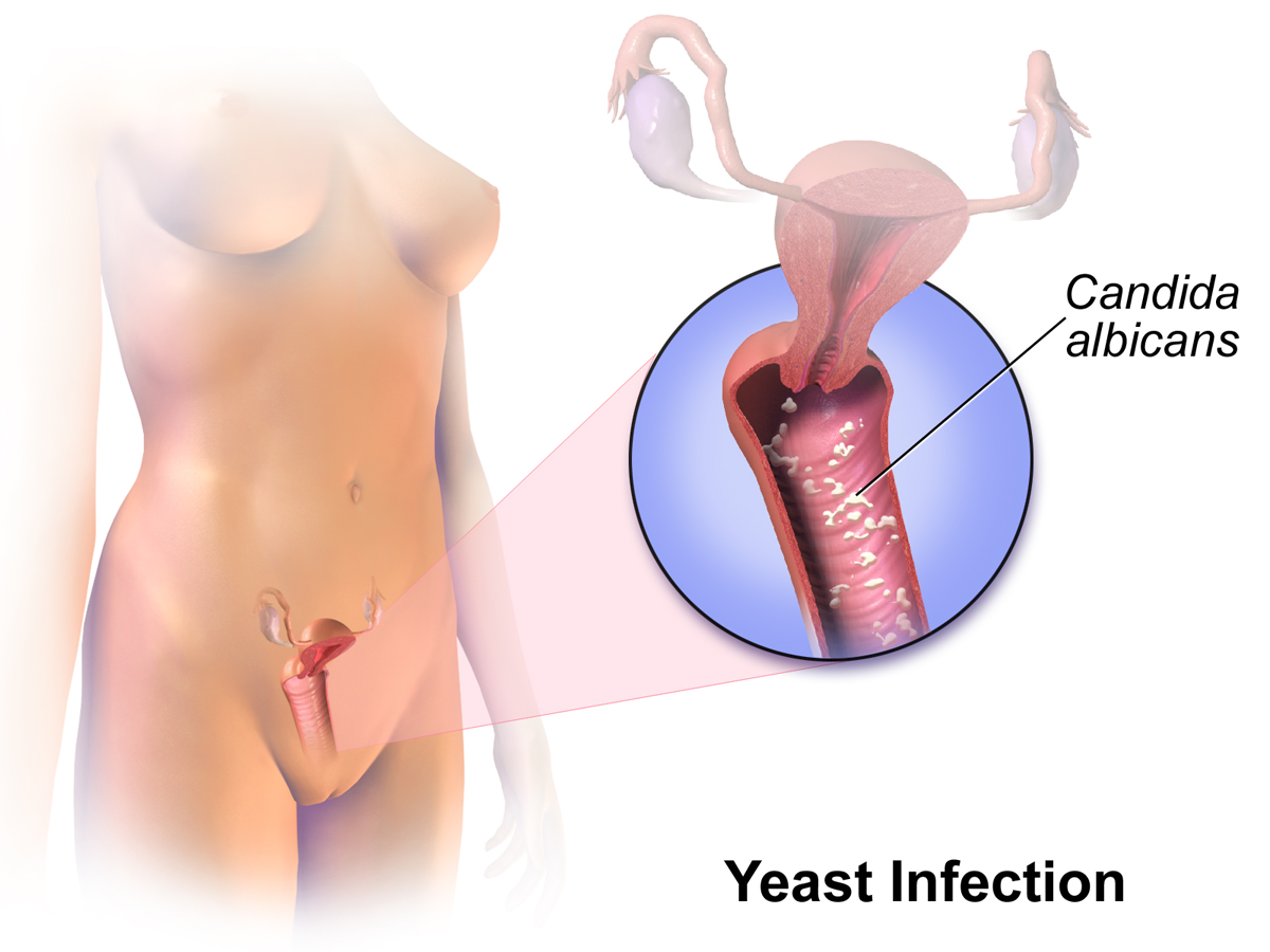 woman uterus and vagina yeast infection