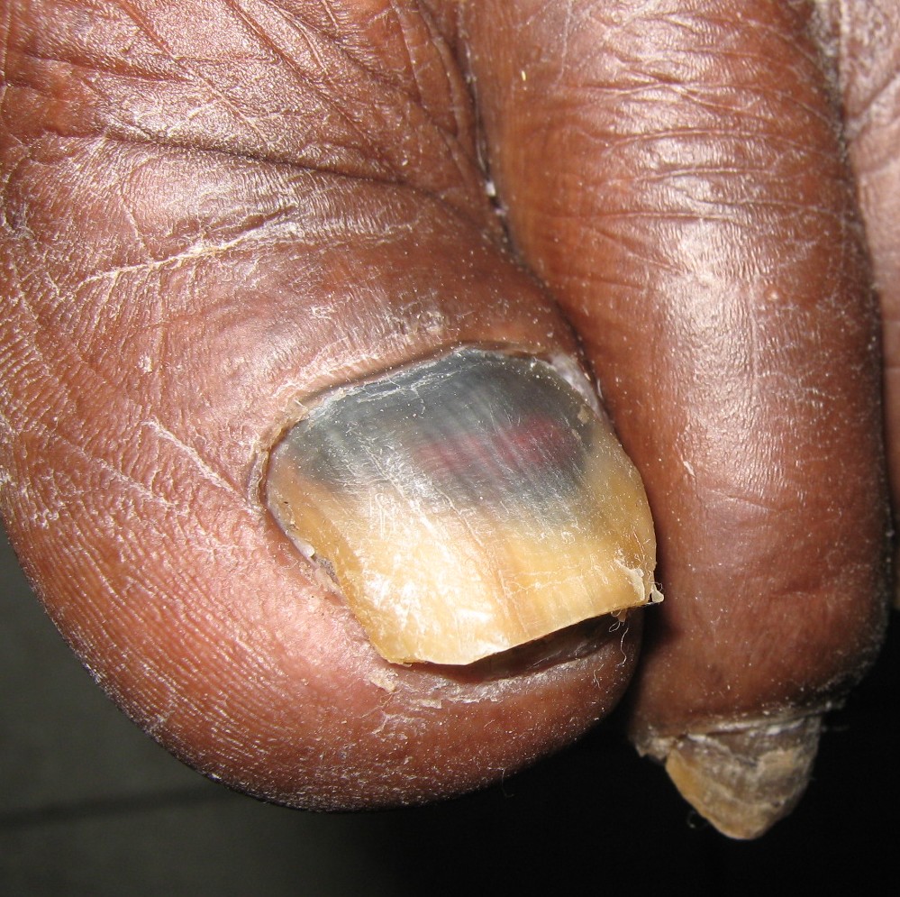 toenail with onychomycosis nail