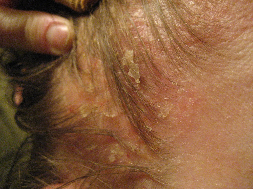 seborrheic dermatitis on the scalp