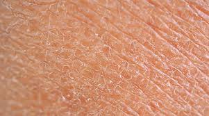 very dry skin